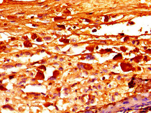 FBN1 / Fibrillin 1 Antibody - Immunohistochemistry image of paraffin-embedded human melanoma cancer at a dilution of 1:100