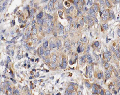 FBN1 / Fibrillin 1 Antibody - 1:100 staining human ovarian carcinoma tissue by IHC-P. The tissue was formaldehyde fixed and a heat mediated antigen retrieval step in citrate buffer was performed. The tissue was then blocked and incubated with the antibody for 1.5 hours at 22°C. An HRP conjugated goat anti-rabbit antibody was used as the secondary.
