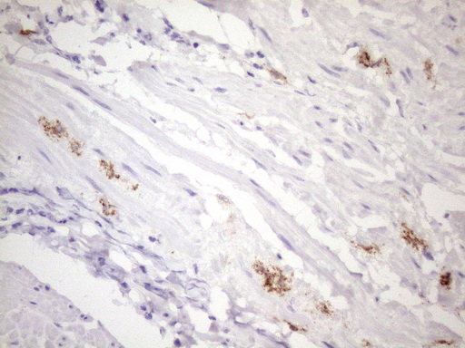 FBP / FOLR2 Antibody - Immunohistochemical staining of paraffin-embedded Carcinoma of Human bladder tissue using anti-FOLR2 mouse monoclonal antibody. (Heat-induced epitope retrieval by 1mM EDTA in 10mM Tris buffer. (pH8.5) at 120 oC for 3 min. (1:150)