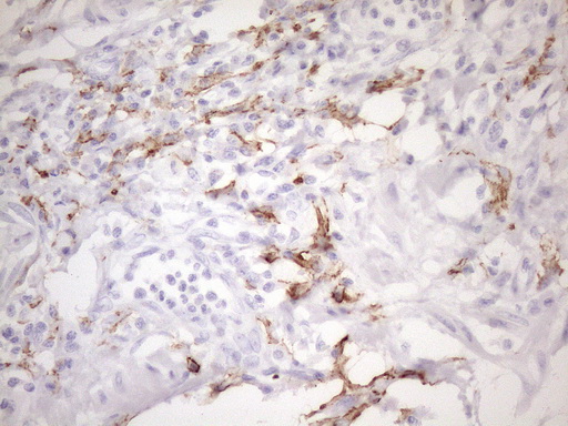 FBP / FOLR2 Antibody - Immunohistochemical staining of paraffin-embedded Adenocarcinoma of Human colon tissue using anti-FOLR2 mouse monoclonal antibody. (Heat-induced epitope retrieval by 1mM EDTA in 10mM Tris buffer. (pH8.5) at 120 oC for 3 min. (1:150)