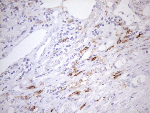 FBP / FOLR2 Antibody - Immunohistochemical staining of paraffin-embedded Carcinoma of Human liver tissue using anti-FOLR2 mouse monoclonal antibody. (Heat-induced epitope retrieval by 1mM EDTA in 10mM Tris buffer. (pH8.5) at 120 oC for 3 min. (1:150)