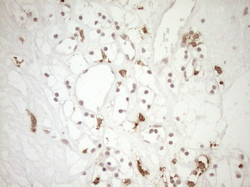 FBP / FOLR2 Antibody - Immunohistochemical staining of paraffin-embedded Carcinoma of Human kidney tissue using anti-FOLR2 mouse monoclonal antibody. (Heat-induced epitope retrieval by 1mM EDTA in 10mM Tris buffer. (pH8.5) at 120°C for 3 min. (1:150)