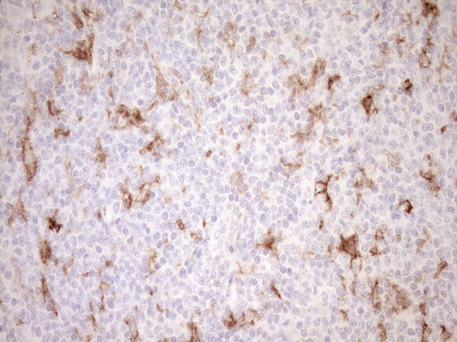FBP / FOLR2 Antibody - Immunohistochemical staining of paraffin-embedded Human lymphoma tissue using anti-FOLR2 mouse monoclonal antibody. (Heat-induced epitope retrieval by 1mM EDTA in 10mM Tris buffer. (pH8.5) at 120°C for 3 min. (1:150)