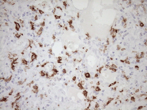 FBP / FOLR2 Antibody - Immunohistochemical staining of paraffin-embedded Carcinoma of Human liver tissue using anti-FOLR2 mouse monoclonal antibody. (Heat-induced epitope retrieval by 1mM EDTA in 10mM Tris buffer. (pH8.5) at 120°C for 3 min. (1:150)
