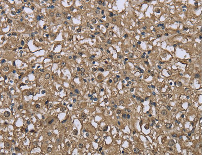 FBP1 Antibody - Immunohistochemistry of paraffin-embedded Human prostate cancer using FBP1 Polyclonal Antibody at dilution of 1:40.
