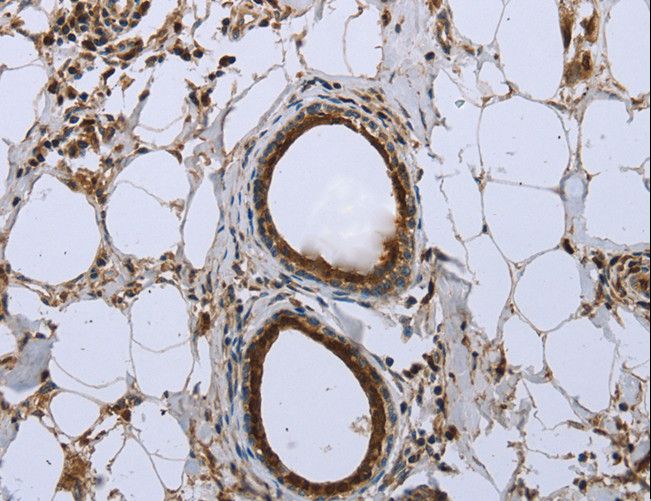 FBP1 Antibody - Immunohistochemistry of paraffin-embedded Human breast cancer using FBP1 Polyclonal Antibody at dilution of 1:40.