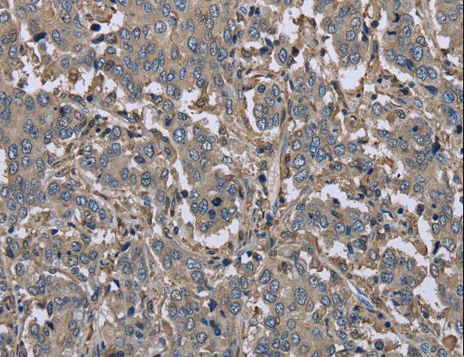 FBP1 Antibody - Immunohistochemistry of paraffin-embedded Human liver cancer using FBP1 Polyclonal Antibody at dilution of 1:30.