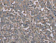 FBP1 Antibody - Immunohistochemistry of paraffin-embedded Human liver cancer using FBP1 Polyclonal Antibody at dilution of 1:30.