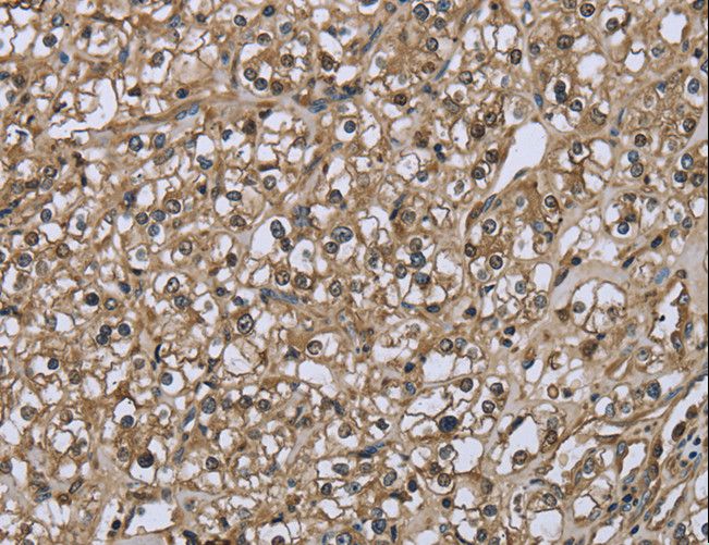 FBP1 Antibody - Immunohistochemistry of paraffin-embedded Human prostate cancer using FBP1 Polyclonal Antibody at dilution of 1:30.
