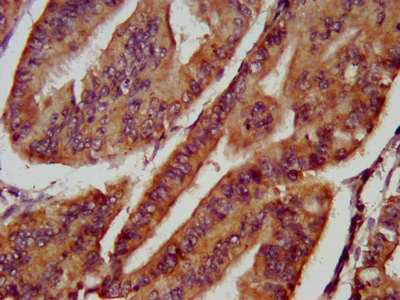 FBXL20 Antibody - Immunohistochemistry image at a dilution of 1:800 and staining in paraffin-embedded human endometrial cancer performed on a Leica BondTM system. After dewaxing and hydration, antigen retrieval was mediated by high pressure in a citrate buffer (pH 6.0) . Section was blocked with 10% normal goat serum 30min at RT. Then primary antibody (1% BSA) was incubated at 4 °C overnight. The primary is detected by a biotinylated secondary antibody and visualized using an HRP conjugated SP system.
