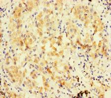 FBXL21 Antibody - Immunohistochemistry of paraffin-embedded human lung cancer at dilution of 1:100