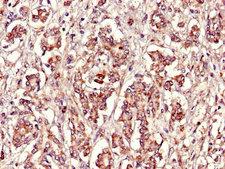 FBXL22 Antibody - Immunohistochemistry of paraffin-embedded human pancreatic cancer using FBXL22 Antibody at dilution of 1:100