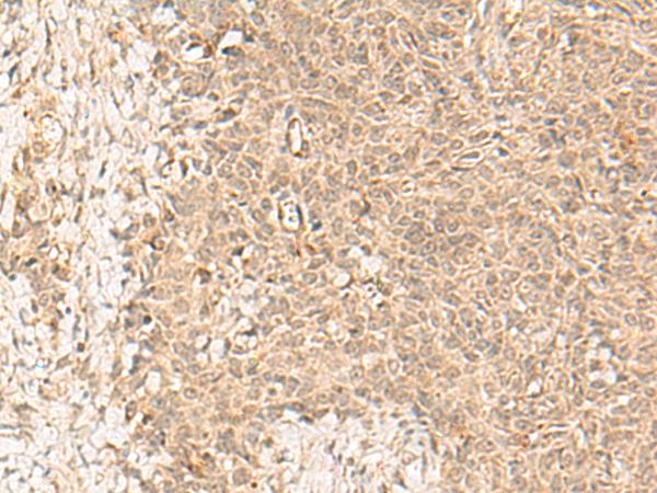 FBXL4 / FBL5 Antibody - Immunohistochemistry of paraffin-embedded Human ovarian cancer tissue  using FBXL4 Polyclonal Antibody at dilution of 1:25(×200)