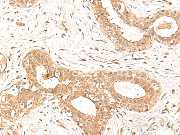 FBXL4 / FBL5 Antibody - Immunohistochemistry of paraffin-embedded Human breast cancer tissue  using FBXL4 Polyclonal Antibody at dilution of 1:25(×200)