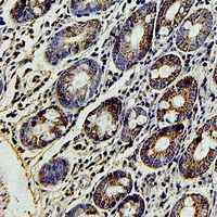 FBXL5 / FBL5 Antibody - Immunohistochemical analysis of FBL5 staining in human colon cancer formalin fixed paraffin embedded tissue section. The section was pre-treated using heat mediated antigen retrieval with sodium citrate buffer (pH 6.0). The section was then incubated with the antibody at room temperature and detected using an HRP conjugated compact polymer system. DAB was used as the chromogen. The section was then counterstained with hematoxylin and mounted with DPX.