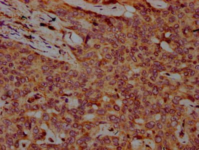 FBXO10 Antibody - Immunohistochemistry Dilution at 1:500 and staining in paraffin-embedded human liver cancer performed on a Leica BondTM system. After dewaxing and hydration, antigen retrieval was mediated by high pressure in a citrate buffer (pH 6.0). Section was blocked with 10% normal Goat serum 30min at RT. Then primary antibody (1% BSA) was incubated at 4°C overnight. The primary is detected by a biotinylated Secondary antibody and visualized using an HRP conjugated SP system.