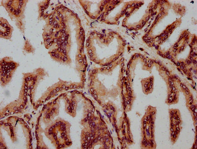 FBXO10 Antibody - Immunohistochemistry Dilution at 1:500 and staining in paraffin-embedded human prostate tissue performed on a Leica BondTM system. After dewaxing and hydration, antigen retrieval was mediated by high pressure in a citrate buffer (pH 6.0). Section was blocked with 10% normal Goat serum 30min at RT. Then primary antibody (1% BSA) was incubated at 4°C overnight. The primary is detected by a biotinylated Secondary antibody and visualized using an HRP conjugated SP system.