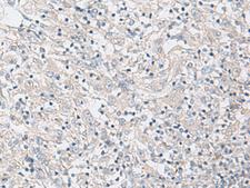 FBXO16 Antibody - Immunohistochemistry of paraffin-embedded Human liver cancer tissue  using FBXO16 Polyclonal Antibody at dilution of 1:60(×200)