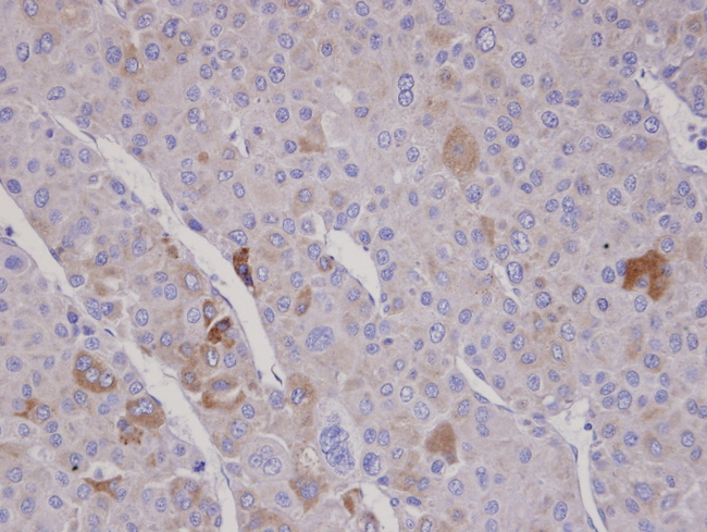 FBXO2 Antibody - IHC of paraffin-embedded Adrenal gland tumor using FBXO2 antibody at 1:100 dilution.