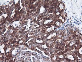 FBXO21 Antibody - IHC of paraffin-embedded Adenocarcinoma of Human ovary tissue using anti-FBXO21 mouse monoclonal antibody.