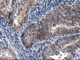 FBXO21 Antibody - IHC of paraffin-embedded Adenocarcinoma of Human endometrium tissue using anti-FBXO21 mouse monoclonal antibody.