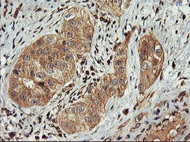 FBXO21 Antibody - IHC of paraffin-embedded Carcinoma of Human bladder tissue using anti-FBXO21 mouse monoclonal antibody.