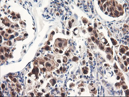 FBXO21 Antibody - IHC of paraffin-embedded Carcinoma of Human lung tissue using anti-FBXO21 mouse monoclonal antibody.