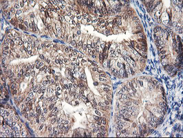 FBXO21 Antibody - IHC of paraffin-embedded Adenocarcinoma of Human endometrium tissue using anti-FBXO21 mouse monoclonal antibody.