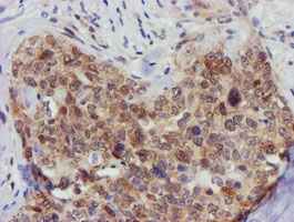 FBXO21 Antibody - IHC of paraffin-embedded Adenocarcinoma of Human breast tissue using anti-FBXO21 mouse monoclonal antibody.