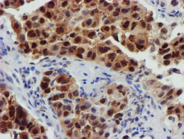 FBXO21 Antibody - IHC of paraffin-embedded Carcinoma of Human lung tissue using anti-FBXO21 mouse monoclonal antibody.