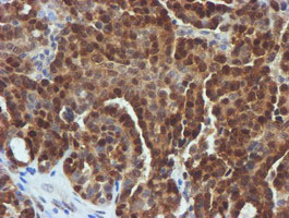FBXO21 Antibody - IHC of paraffin-embedded Adenocarcinoma of Human ovary tissue using anti-FBXO21 mouse monoclonal antibody.