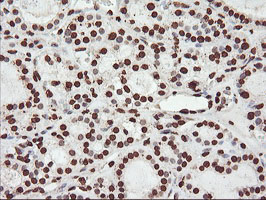 FBXO21 Antibody - IHC of paraffin-embedded Carcinoma of Human thyroid tissue using anti-FBXO21 mouse monoclonal antibody.
