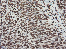 FBXO21 Antibody - IHC of paraffin-embedded Carcinoma of Human bladder tissue using anti-FBXO21 mouse monoclonal antibody.