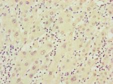 FBXO22 Antibody - Immunohistochemistry of paraffin-embedded human liver cancer at dilution of 1:100
