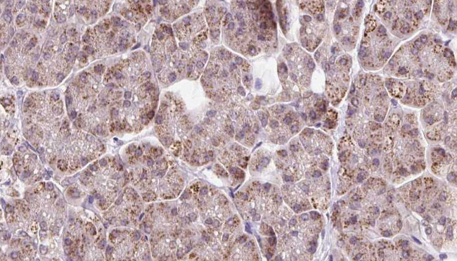 FBXO22 Antibody - 1:100 staining human pancreas carcinoma tissue by IHC-P. The sample was formaldehyde fixed and a heat mediated antigen retrieval step in citrate buffer was performed. The sample was then blocked and incubated with the antibody for 1.5 hours at 22°C. An HRP conjugated goat anti-rabbit antibody was used as the secondary.