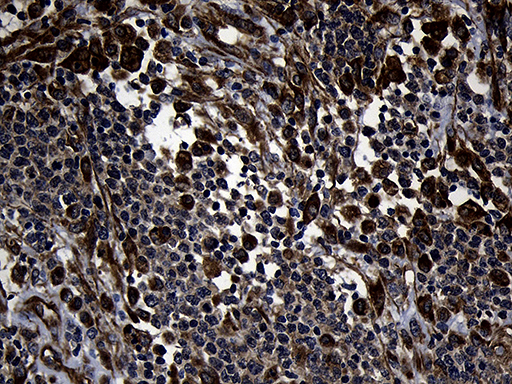 FBXO25 Antibody - Immunohistochemical staining of paraffin-embedded Human lymphoma tissue using anti-FBXO25 mouse monoclonal antibody. (Heat-induced epitope retrieval by 1mM EDTA in 10mM Tris buffer. (pH8.5) at 120°C for 3 min. (1:150)(1:500)