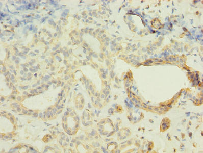 FBXO28 Antibody - Immunohistochemistry of paraffin-embedded human breast cancer using FBXO28 Antibody at dilution of 1:100