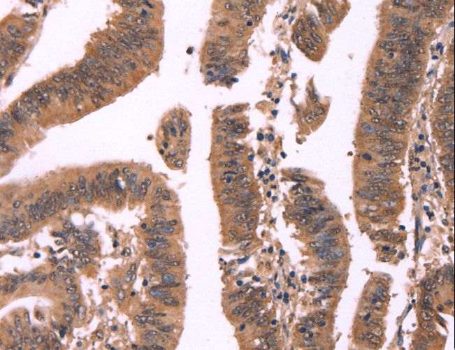 FBXO31 Antibody - Immunohistochemistry of paraffin-embedded Human colon cancer using FBXO31 Polyclonal Antibody at dilution of 1:40.