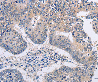 FBXO32 / Fbx32 Antibody - Immunohistochemistry of paraffin-embedded human colon cancer tissue using FBXO32 antibody.
