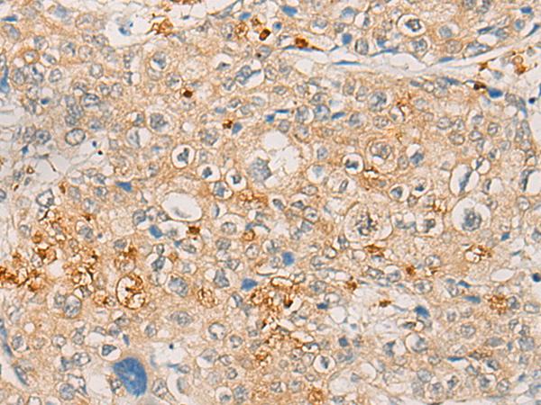 FBXO32 / Fbx32 Antibody - Immunohistochemistry of paraffin-embedded Human prost ate cancer tissue  using FBXO32 Polyclonal Antibody at dilution of 1:45(×200)