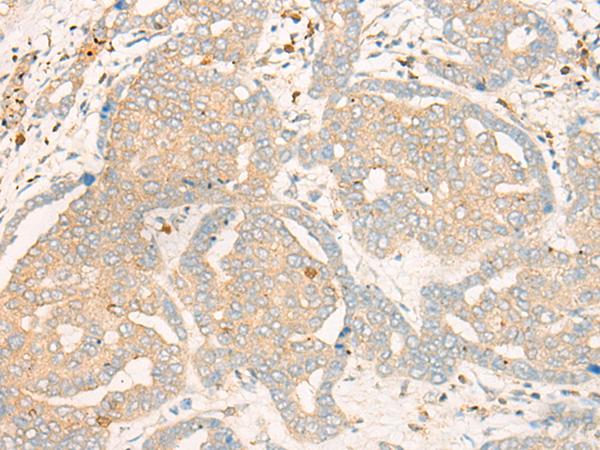 FBXO32 / Fbx32 Antibody - Immunohistochemistry of paraffin-embedded Human liver cancer tissue  using FBXO32 Polyclonal Antibody at dilution of 1:35(×200)