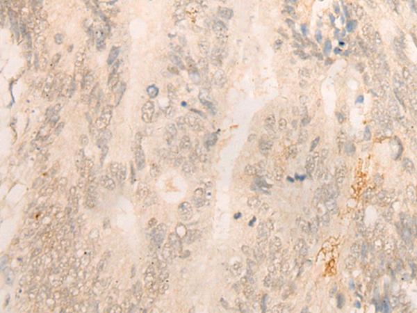 FBXO32 / Fbx32 Antibody - Immunohistochemistry of paraffin-embedded Human colorectal cancer tissue  using FBXO32 Polyclonal Antibody at dilution of 1:35(×200)