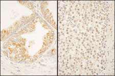 FBXO38 Antibody - Detection of Human FBXO38 by Immunohistochemistry. Sample: FFPE section of human prostate carcinoma (right) and human testicular seminoma (right). Antibody: Affinity purified rabbit anti-FBXO38 used at a dilution of 1:1000 (1 ug/ml). Detection: DAB.