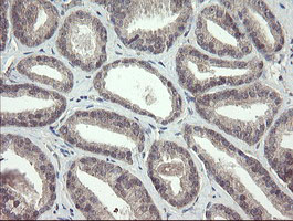FBXO42 / JFK Antibody - IHC of paraffin-embedded Carcinoma of Human prostate tissue using anti-FBXO42 mouse monoclonal antibody.