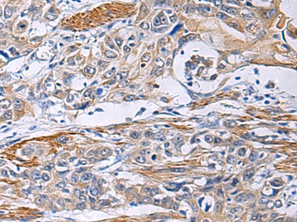 FBXO45 Antibody - Immunohistochemistry of paraffin-embedded Human esophagus cancer tissue  using FBXO45 Polyclonal Antibody at dilution of 1:40(×200)