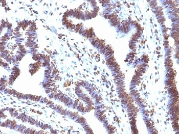 FBXO5 / EMI1 Antibody - Formalin-fixed, paraffin-embedded human ovarian carcinoma stained with EMI1 antibody (EMI1/1176).  This image was taken for the unmodified form of this product. Other forms have not been tested.