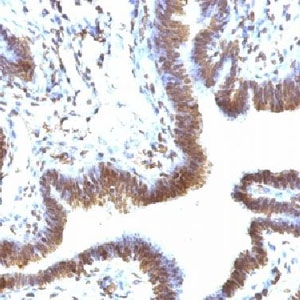 FBXO5 / EMI1 Antibody - IHC testing of FFPE human ovarian carcinoma and EMI-1 antibody (FBXP5).  This image was taken for the unmodified form of this product. Other forms have not been tested.