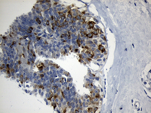 FBXO6 Antibody - Immunohistochemical staining of paraffin-embedded Human breast tissue within the normal limits using anti-FBXO6 mouse monoclonal antibody. (Heat-induced epitope retrieval by 1mM EDTA in 10mM Tris buffer. (pH8.5) at 120°C for 3 min. (1:150)