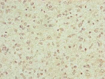 FBXO6 Antibody - Immunohistochemistry of paraffin-embedded human glioma cancer at dilution of 1:100