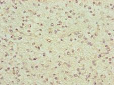 FBXO6 Antibody - Immunohistochemistry of paraffin-embedded human glioma cancer at dilution of 1:100